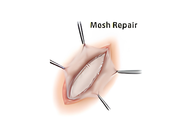 Umbilical hernia repair sequence